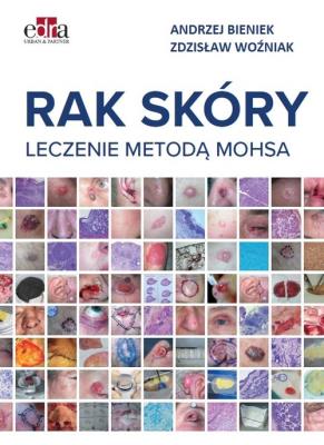 Rak skóry Leczenie metodą Mohsa. Autor: Bieniek Andrzej, Woźniak Zdzisław. SmakLiter.pl Okładka książki Rak skóry Leczenie metodą Mohsa